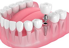 Illustration of a single dental implant