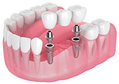 Illustration of an implant bridge