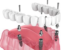 Illustration of an implant denture