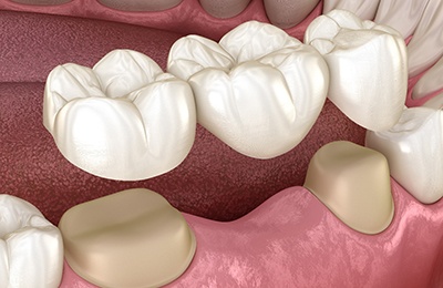 Closeup of how a dental bridge in Brownstown is placed