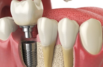An implant in the lower jaw