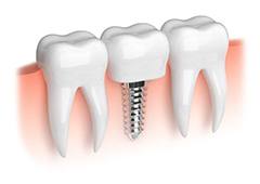 Diagram of an integrated dental implant in Brownstown