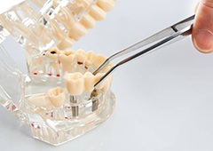 Implant dentist in Brownstown placing restoration onto implant model