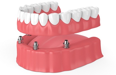 implant-retained dentures