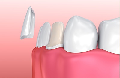 fron illustration of veneer