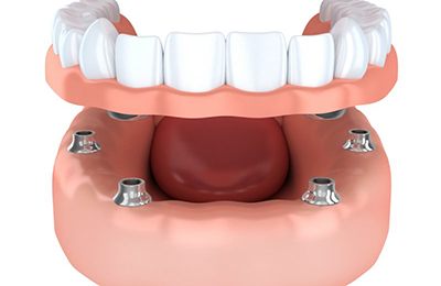 implant-retained dentures 