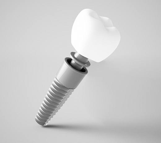single tooth dental implant white crown