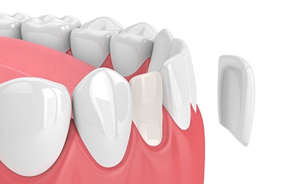 Model of a dental veneer.