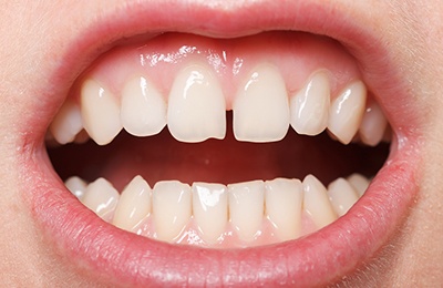 Woman with chipped and gapped teeth.