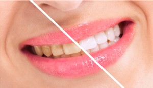 Restore your smile with professional teeth whitening in Brownstown.