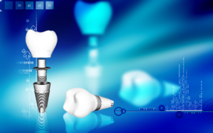 dental implants