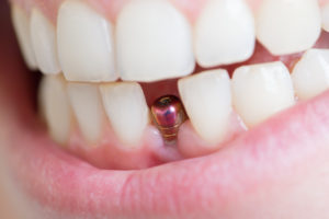 mouth open showing dental implant