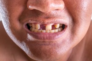 close up of man with missing teeth