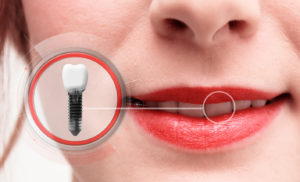 Dental implant graphic next to woman's smile