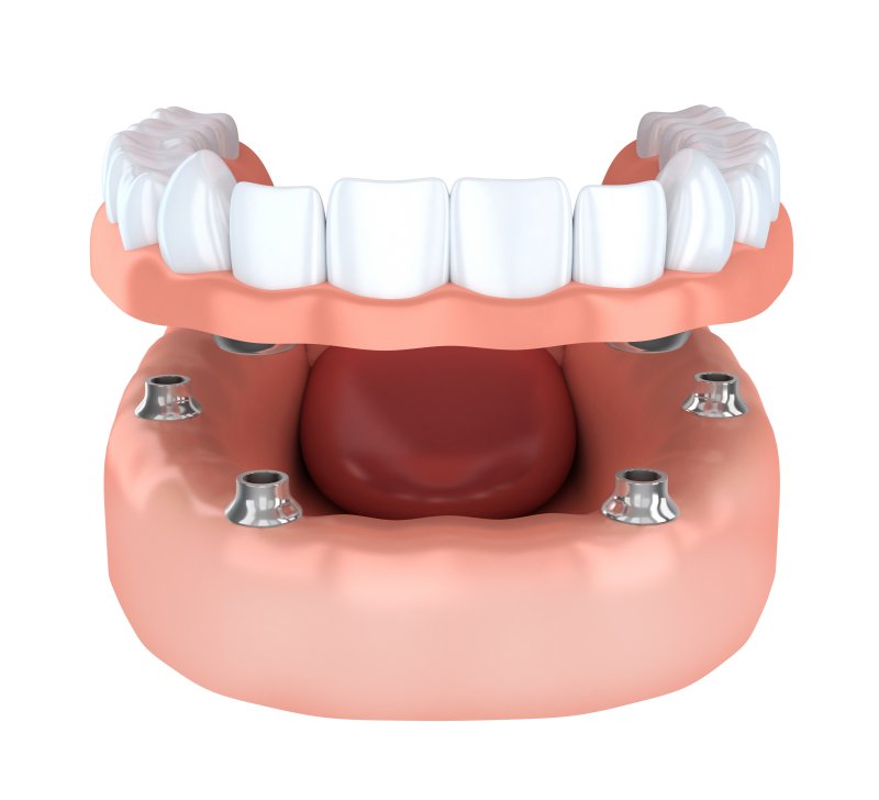 a digital image of an implant denture and six posts on the lower arch