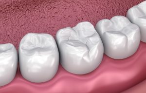 Digital image of tooth-colored fillings